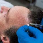 Scalp Micropigmentation